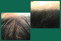 میکرو اسکالپ آزاده گلشنی، متخصص میکرو اسکالپ در لنگرود، بهترین مرکز کاشت مو در لنگرود، میکرو اسکالپ 09021607199 در رشت، مرکز تخصصی کراتین و بوتاکس مو در رشت